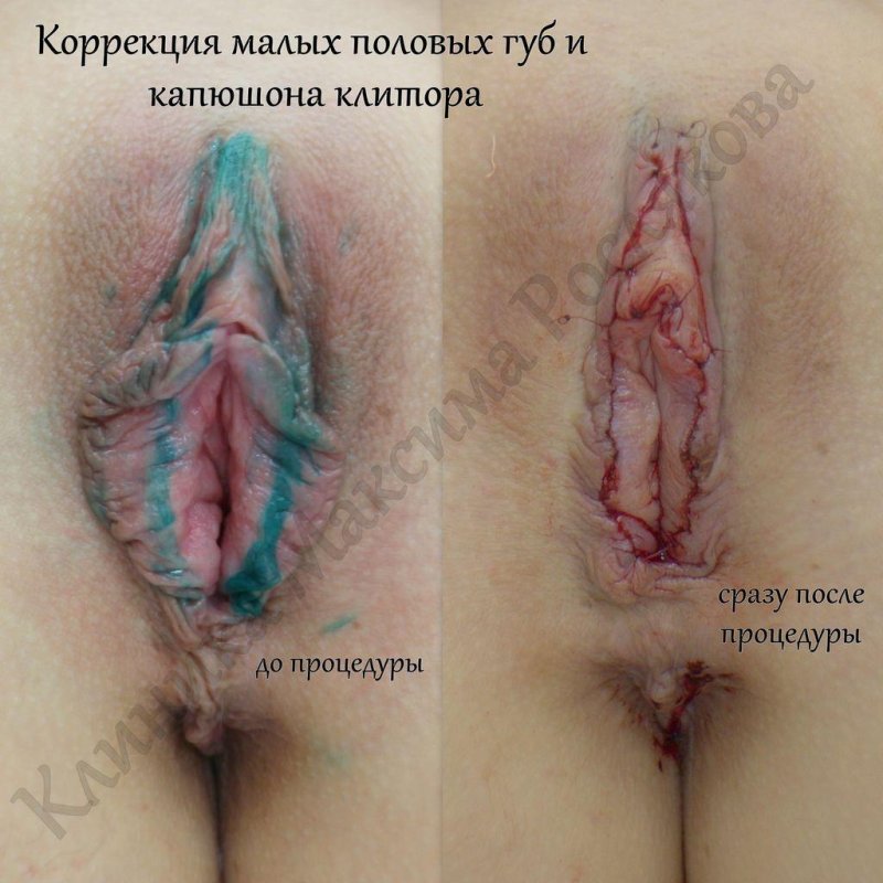 Пластика малых половых губ