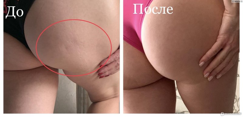 Вакуумные банки от целлюлита до и после
