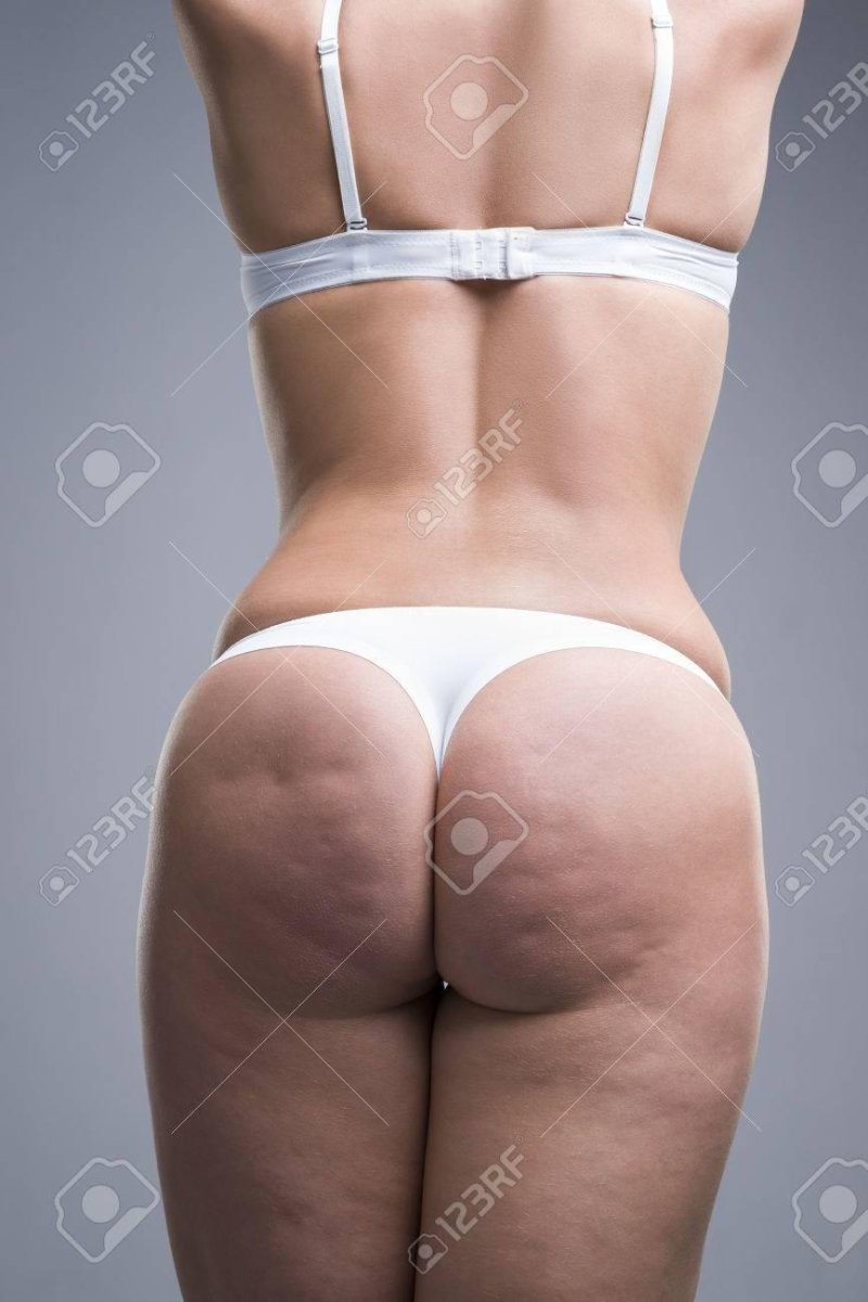 Cellulite hips